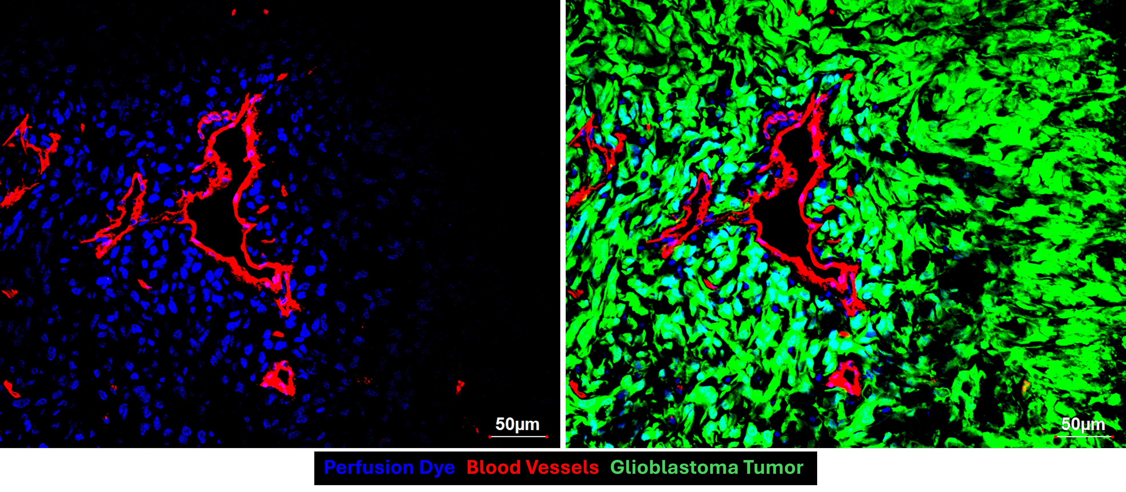 PFDLC labelling — perfusion dye in blue, blood vessels in red, glioblastoma tumor in green